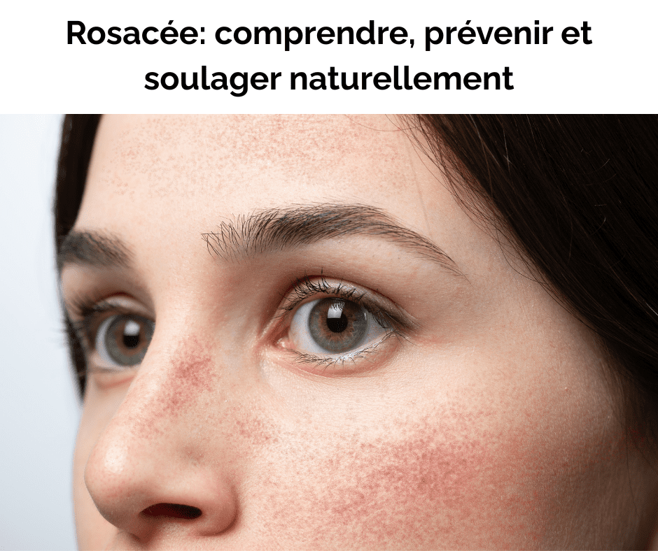 Rosacée: comprendre, prévenir et soulager naturellement